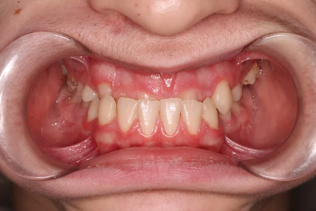 კბილების მდგომარეობა მკურნალობამდე, NB Dental