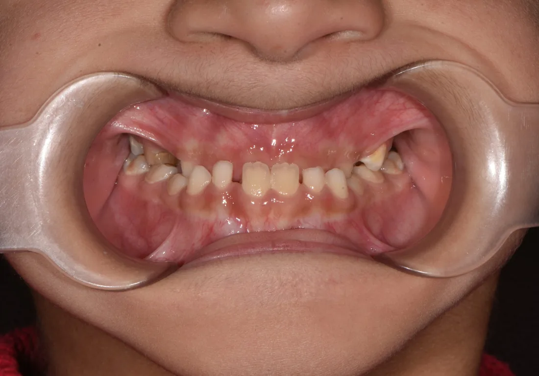 კბილების მდგომარეობა მკურნალობამდე, NB Dental