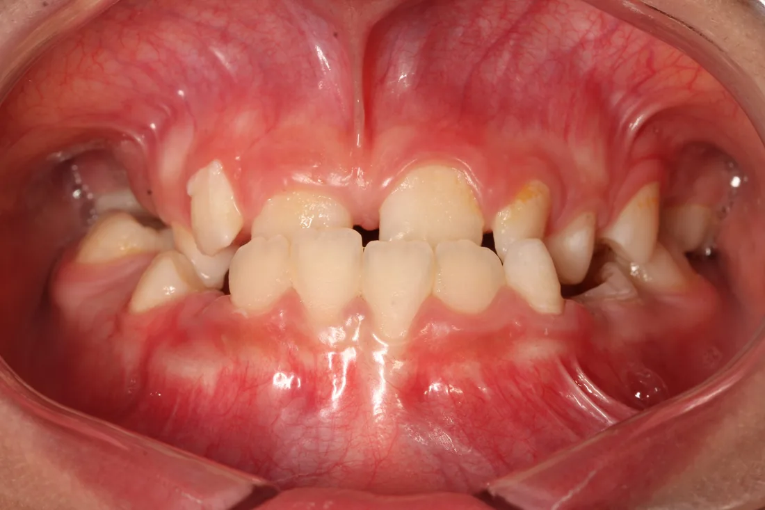 კბილების მდგომარეობა მკურნალობამდე, NB Dental
