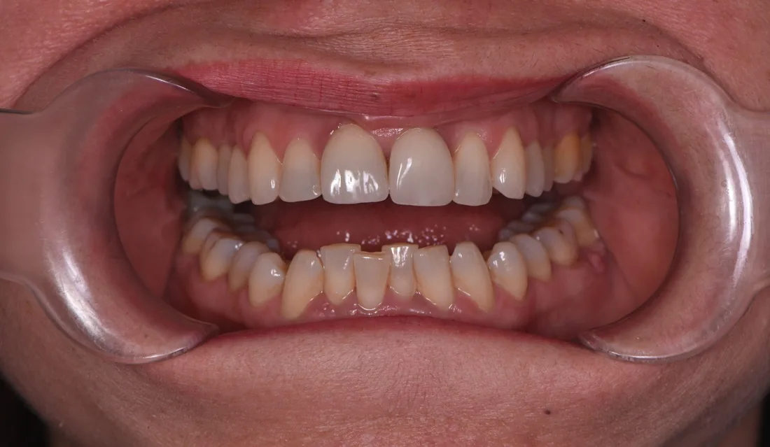 კბილების მდგომარეობა მკურნალობამდე, NB Dental
