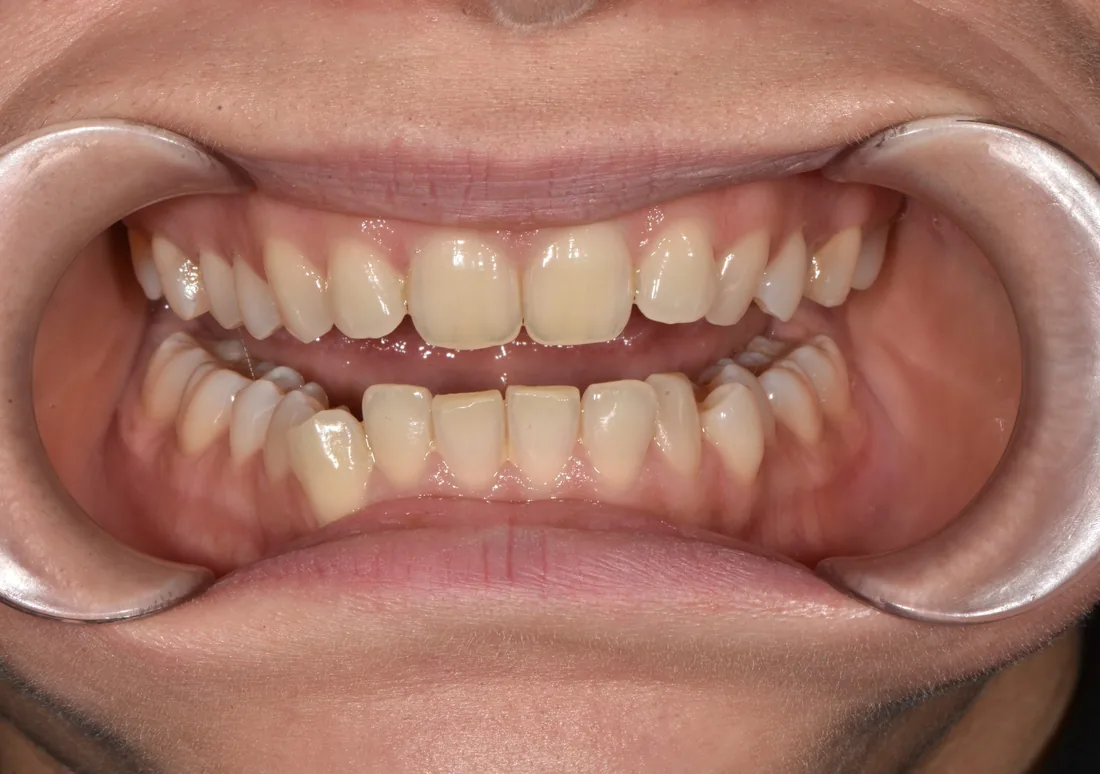 კბილების მდგომარეობა მკურნალობამდე, NB Dental
