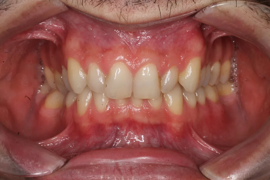 კბილების მდგომარეობა მკურნალობამდე, NB Dental