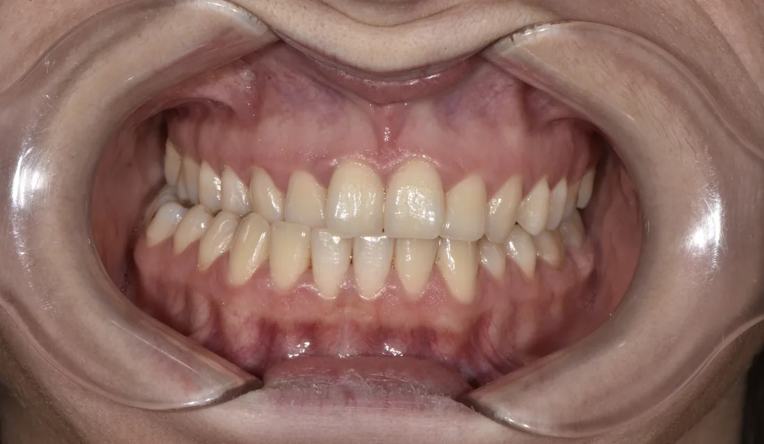კბილების მდგომარეობა მკურნალობამდე, NB Dental