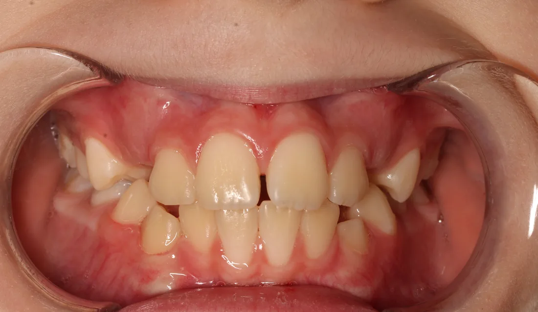 კბილების მდგომარეობა მკურნალობამდე, NB Dental