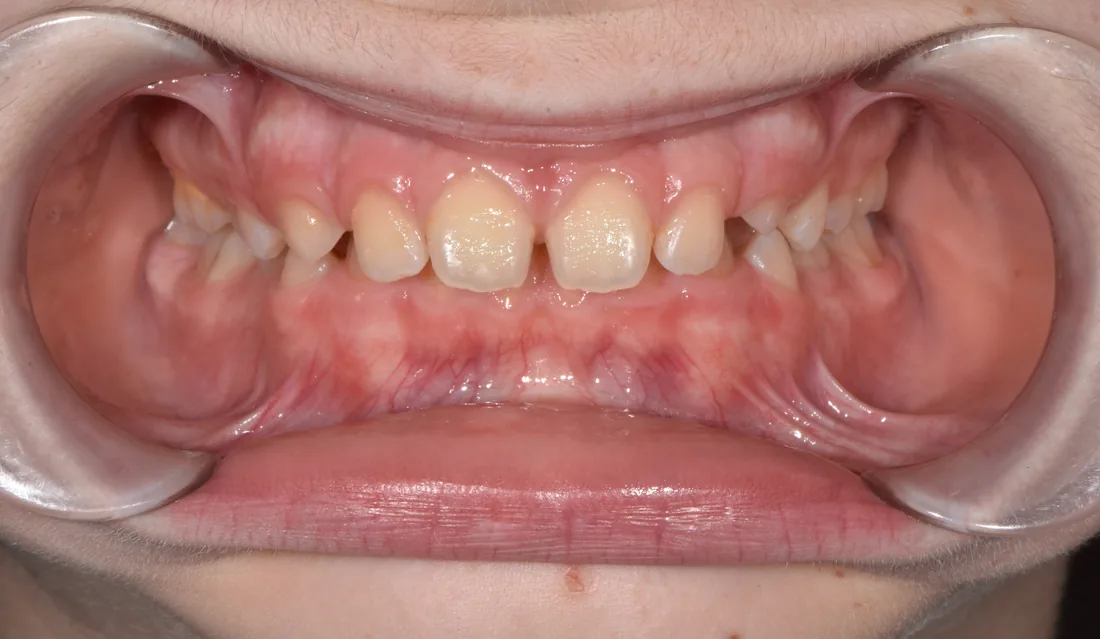 კბილების მდგომარეობა მკურნალობამდე, NB Dental