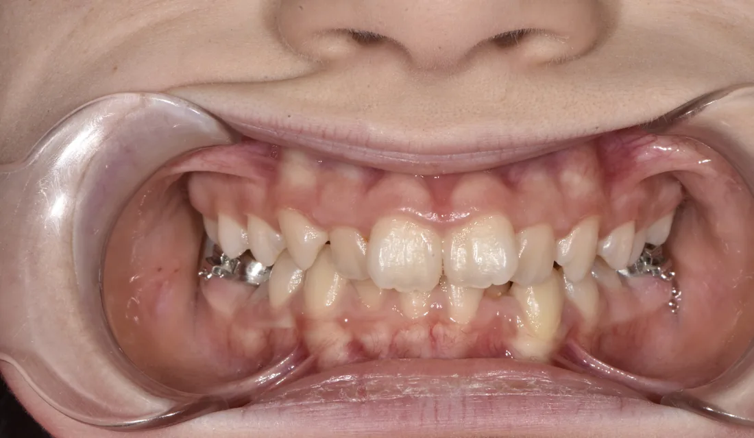 კბილების მდგომარეობა მკურნალობამდე, NB Dental